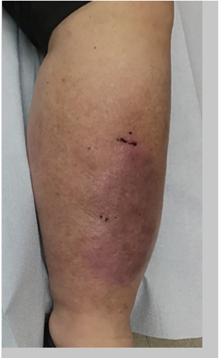 Patient leg after vein disease treatment