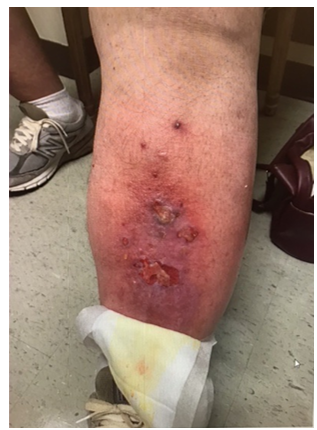 Patient leg before vein disease treatment