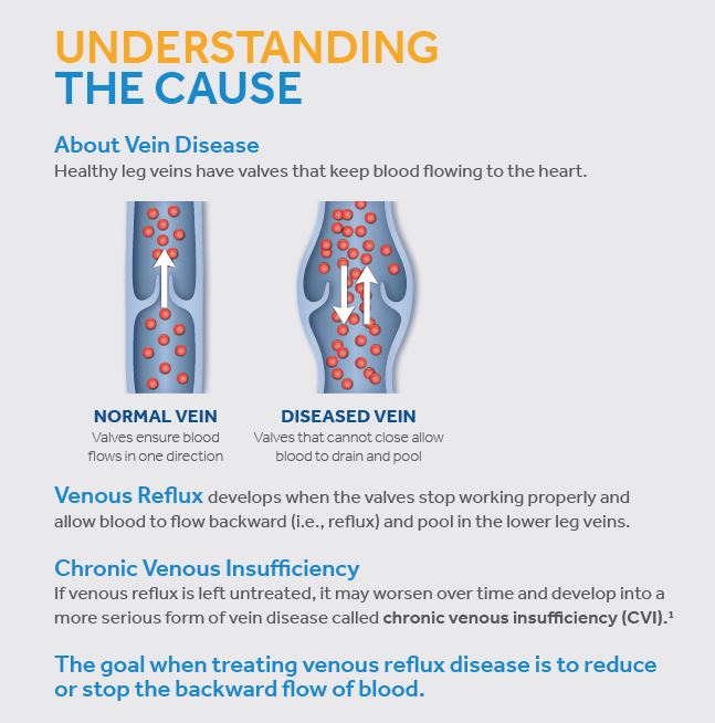 Diagram showing the cause of vein disease in the legs